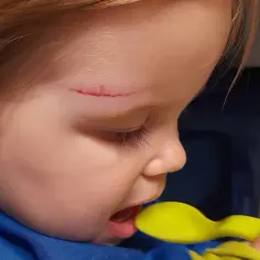 Małe dziecko z zadrapaniem na czole, które zastanawia się, co na guza u dziecka.