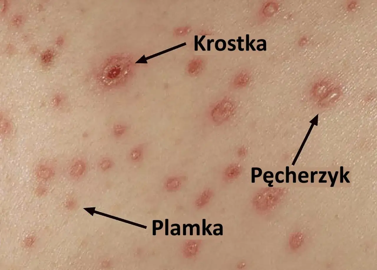 Skóra po ospie: plamki, krostki i pęcherzyki. Dziecko czeka na powrót do przedszkola.
